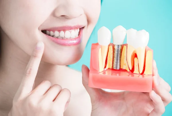Implants